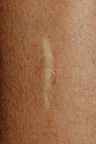 Photo d'une cicatrice